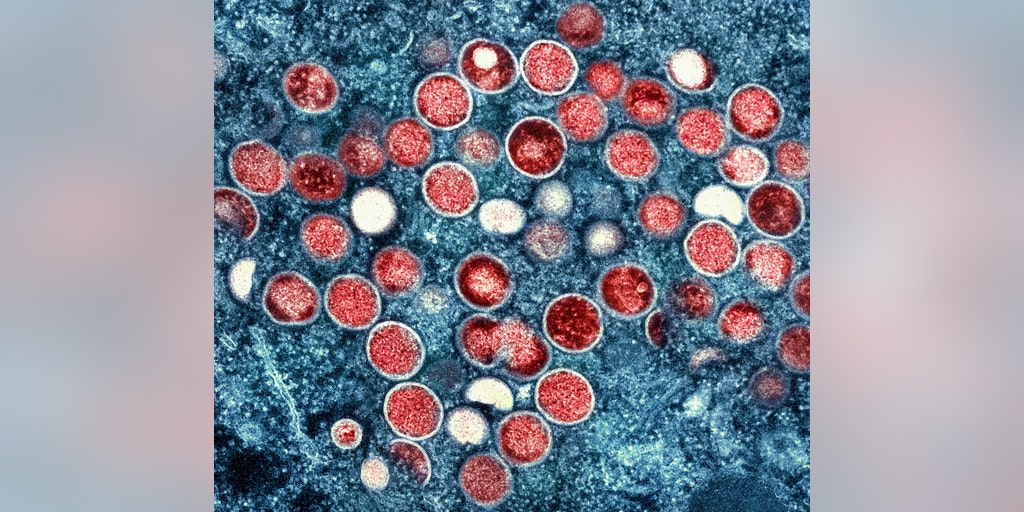 Iran announces first official case of monkeypox: 34-year-old woman tests positive - Vimarsana News