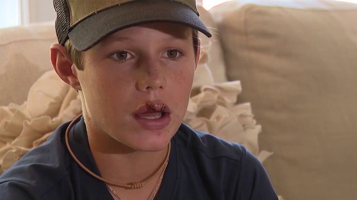 Florida boy Fischer Hricko was bitten on the face by a nurse shark