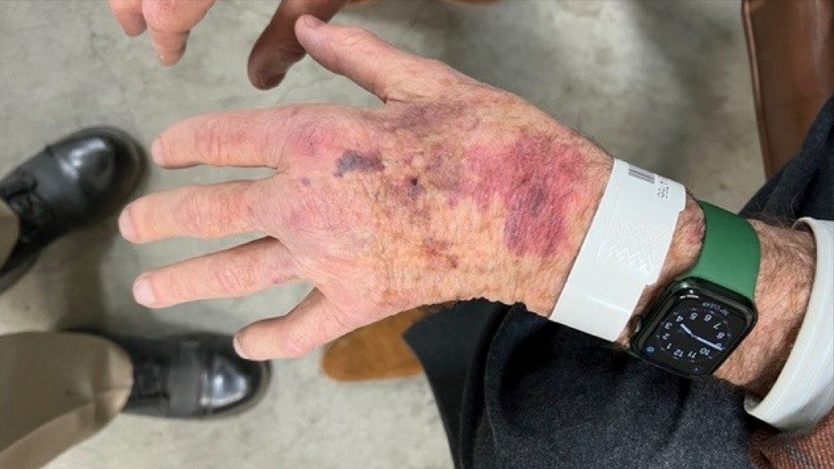 Bruises on Paul Pelosi's hands