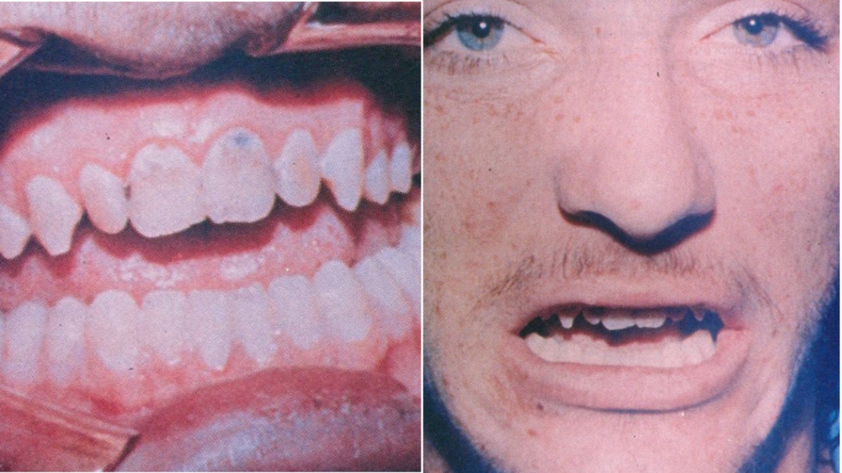 Photos of Robert Duboise's mouth and ostensible bite marks 