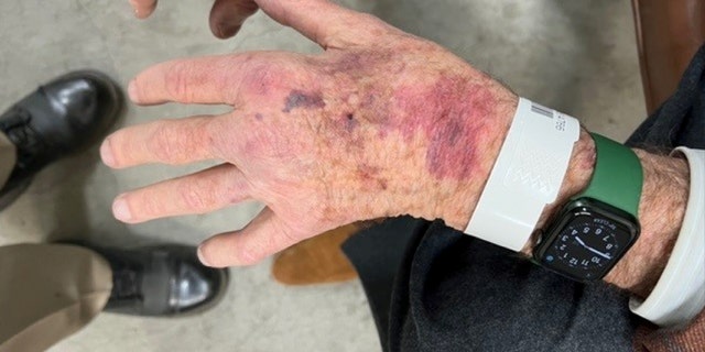 Bruises shown on Paul Pelosi's hands after his May DUI crash.