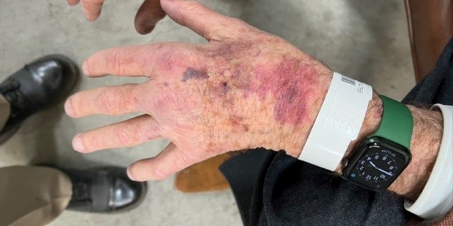 Bruises shown on Paul Pelosi's hands after his May DUI crash.