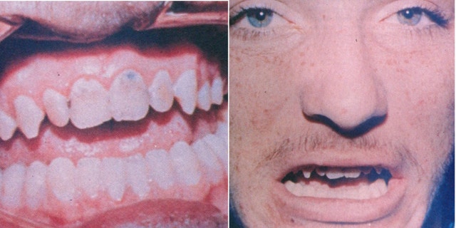 Evidence photos of Robert DuBoise's teeth that supposedly tied him to a bite mark on victim Barbara Grams' face. Bite-mark analysis has since been broadly rejected by the scientific community. 