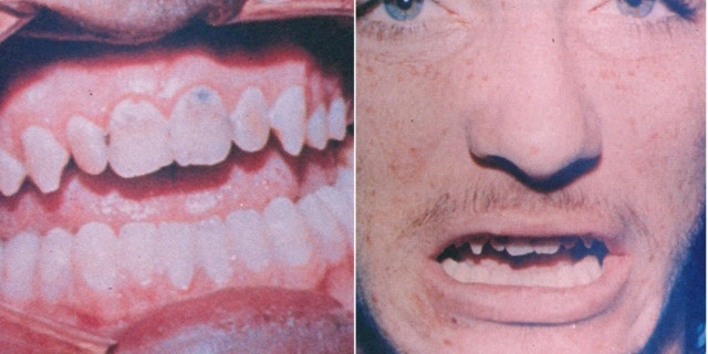 Evidence photos of Robert DuBoise's teeth that supposedly tied him to a bite mark on victim Barbara Grams' face. Bite-mark analysis has since been broadly rejected by the scientific community. 