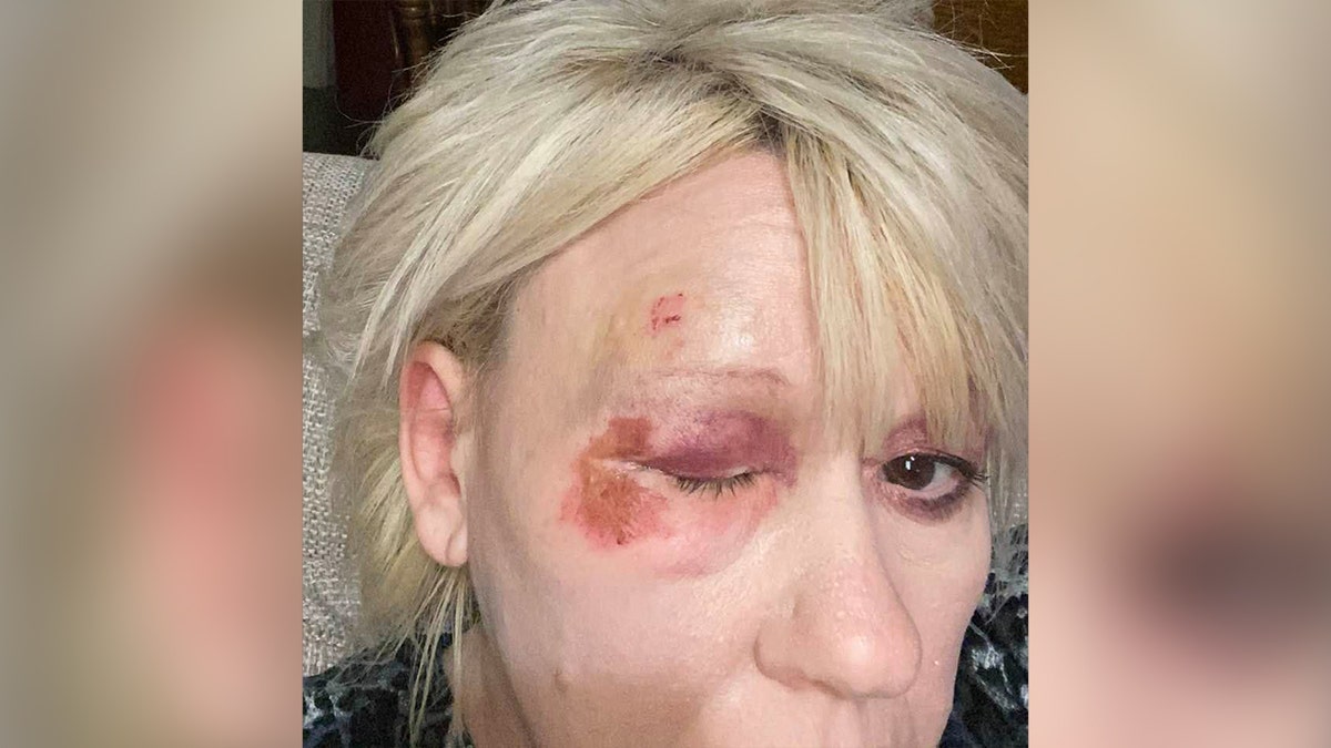 Bruising on Debbie Collier's face around her right eye