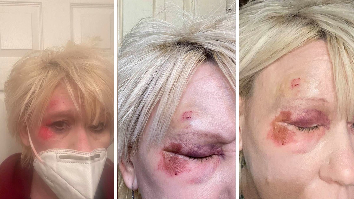 Composite of 3 photos showing Bruising on Debbie Collier's face around her right eye