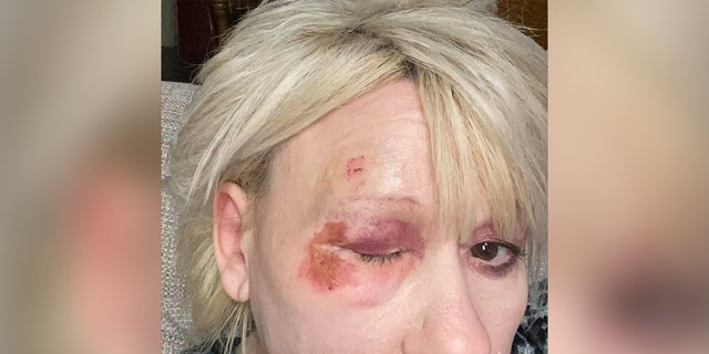 Debbie Collier posted on Facebook on December 8, 2020. "planted face" I injured my eye on the sidewalk.