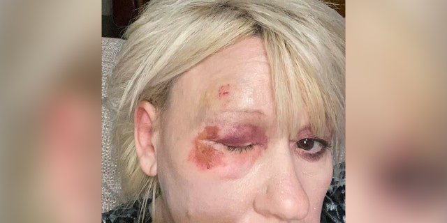 Debbie Collier posted to Facebook on Dec. 8, 2020, that she had "face planted" and injured her eye on the sidewalk.