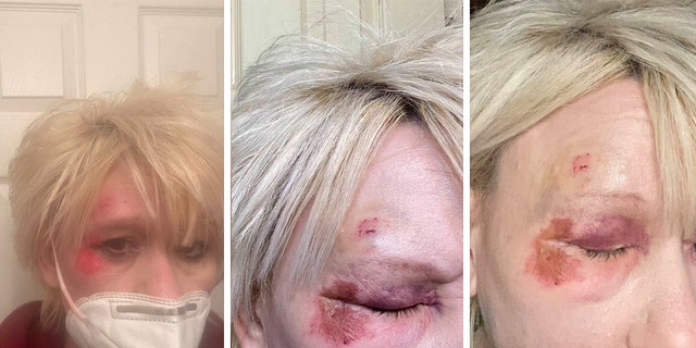 Debbie Collier posted to Facebook on Dec. 8, 2020, that she had "face planted" and injured her eye on the sidewalk.