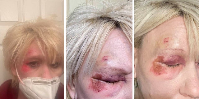 Debbie Collier posted to Facebook on Dec. 8, 2020, that she had "face planted" and injured her eye on the sidewalk.