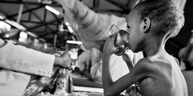 A severely malnourished Somali child is seen at the Doctors Without Borders hospital in Dagahaley refugee camp on August 20, 2011.