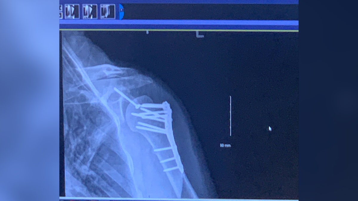 X-ray showing screans and plates in Dustan Jackson's shoulder