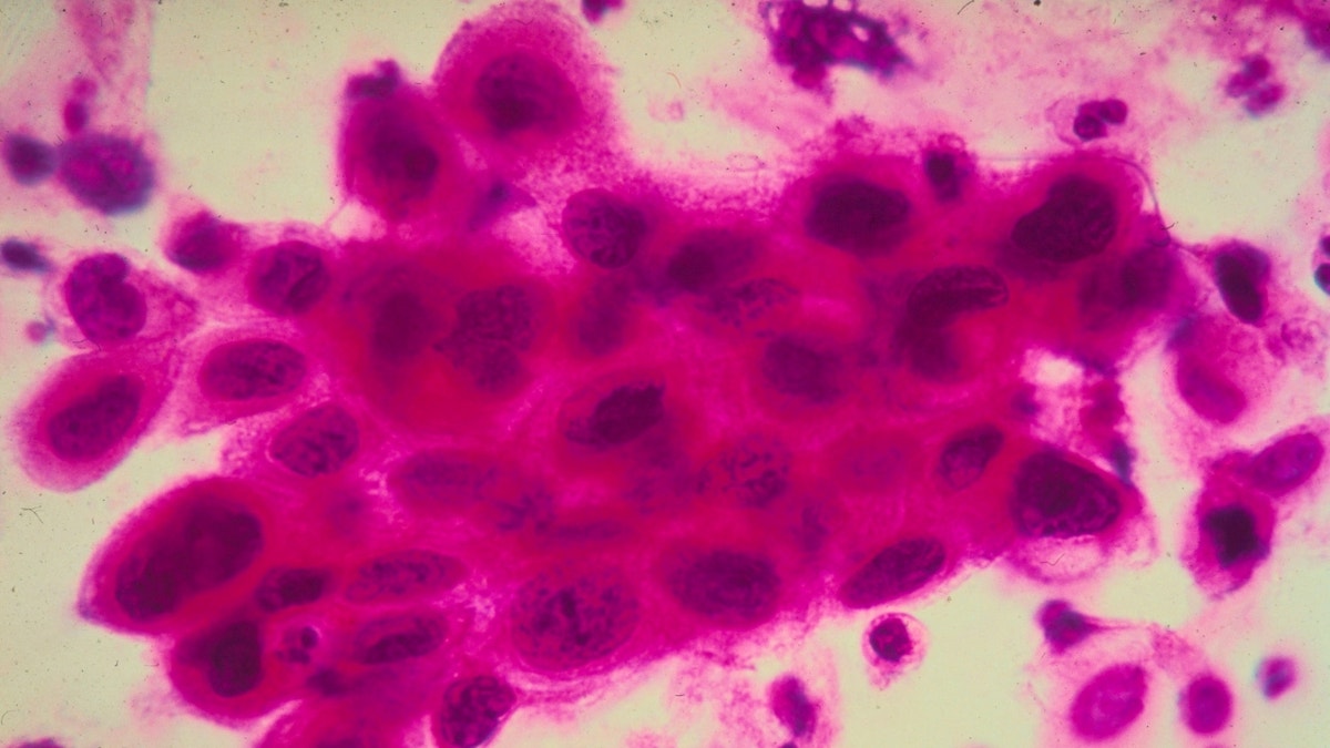 Cancer cells in uterus