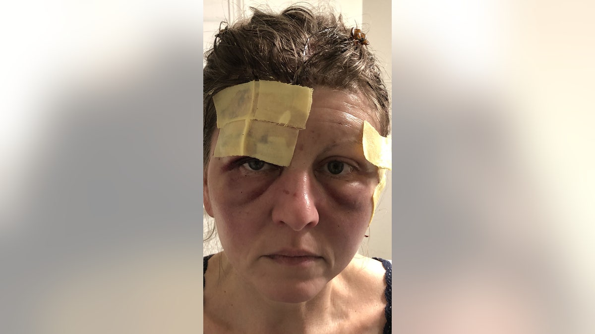 Renee Levow, attacked by a bear