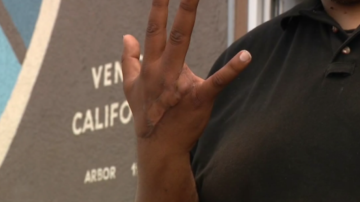 Tariq Ali showing his scarred hand