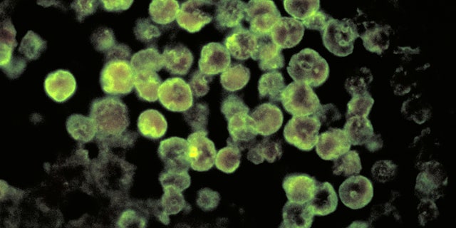 Using the direct fluorescent antibody (DFA) staining technique, this photomicrograph depicts the histopathologic characteristics associated with a case of amebic meningoencephalitis due to Naegleria fowleri parasites.