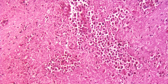 Under a magnification of 125X, this photomicrograph of a brain tissue specimen depicts the cytoarchitectural changes associated with a free-living, Naegleria fowleri, amebic infection.