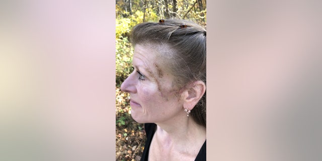 Levow has scarring from her stitches. Some of the injuries to the left side of her face can be seen in this photo.