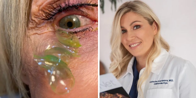 Contacts appear sticking out of the patient's eye (left); Dr. Katerina Corteva is shown on the right. "I've been in practice for 19 years and this is the first time I've come across a situation like this," She told Fox News Digital.