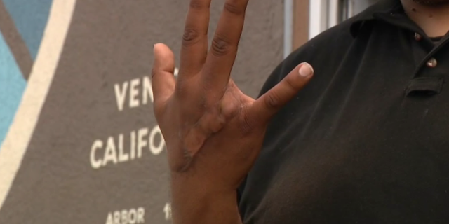 The homeless man's saliva infected Tariq's finger wound, leading to an amputation.
