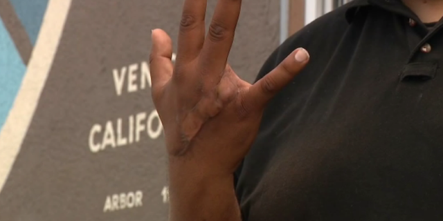 The homeless man's saliva infected Tariq's finger wound, leading to an amputation.