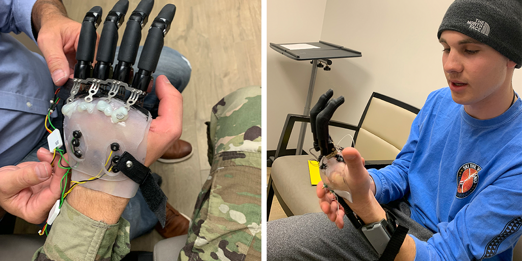 Veteran of US Army regains ability to move fingers with new procedure, prosthetics: Hope for 'normal future' - Vimarsana News