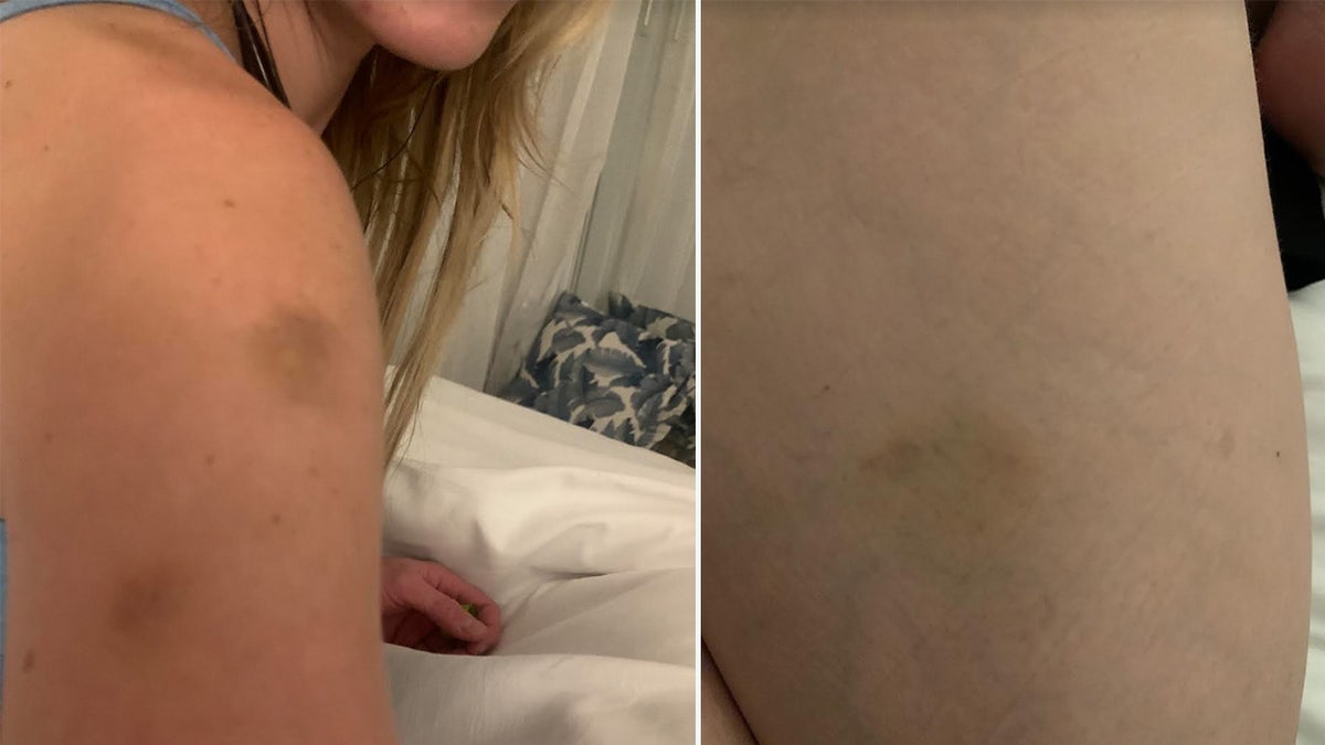 Courtney Clenney showing bruises on her arm, leg