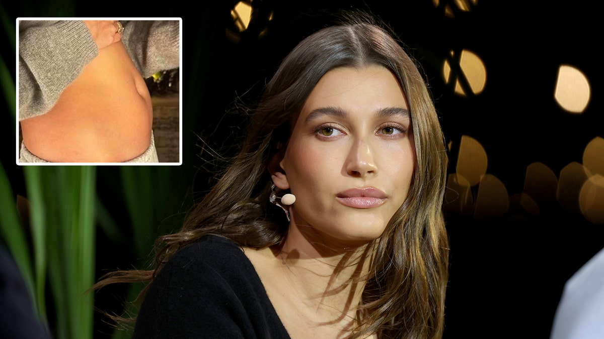 Hailey Bieber is ’emotional’ from ovarian cyst: ‘Not a baby’
