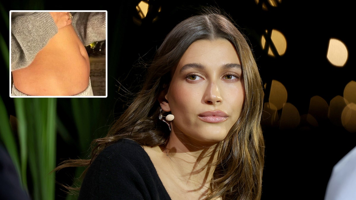 Hailey Bieber looks off in the distance in a black outfit inset a photo of her stomach after revealing she has an ovarian cyst