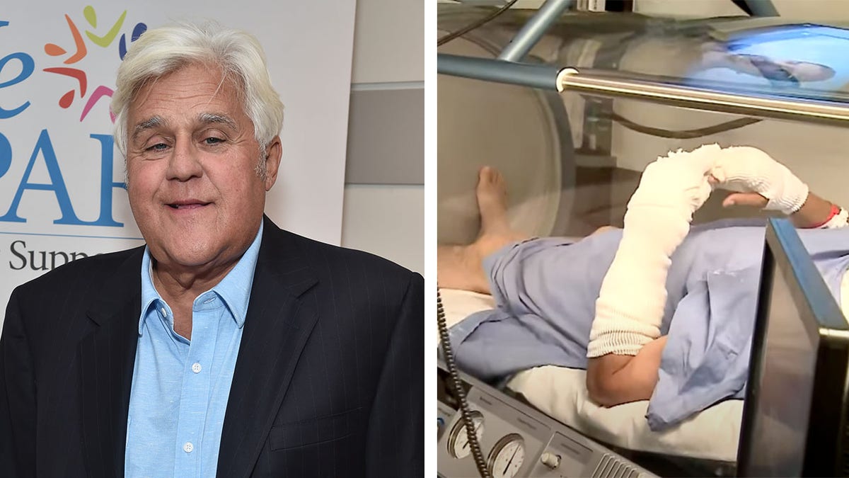 Jay Leno treated for burns in hyperbaric chamber