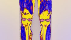 Common joint pain treatment may be making arthritis worse, studies suggest