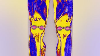 Common joint pain treatment may be making arthritis worse, studies suggest