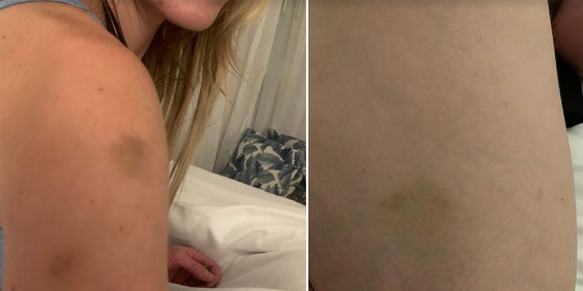 Courtney Clenney had numerous bruises after she allegedly stabbed Christian Obumseli to death on April 3, 2022. The photos were reportedly taken by Clenney's mom.