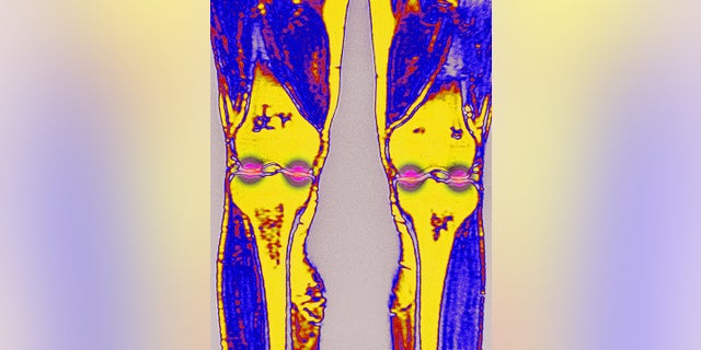 FILE: Osteoarthritis of the knee.  Wear then the destruction of cartilage in various areas of the knee joint.  Frontal MRI of the knees.