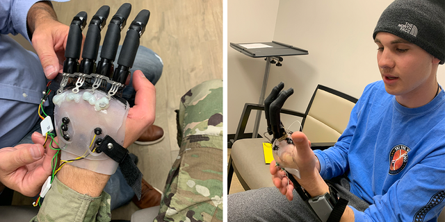 Veteran Of US Army Regains Ability To Move Fingers With New Procedure ...