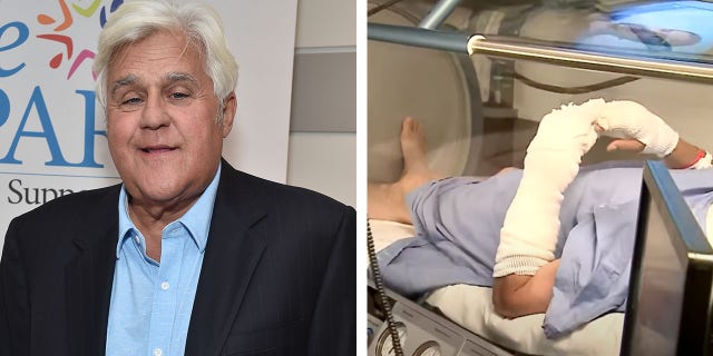 After comedian and classic car collector Jay Leno suffered from "serious burns" in a gasoline fire while working on one of his vehicles, the 72-year-old underwent treatment. 