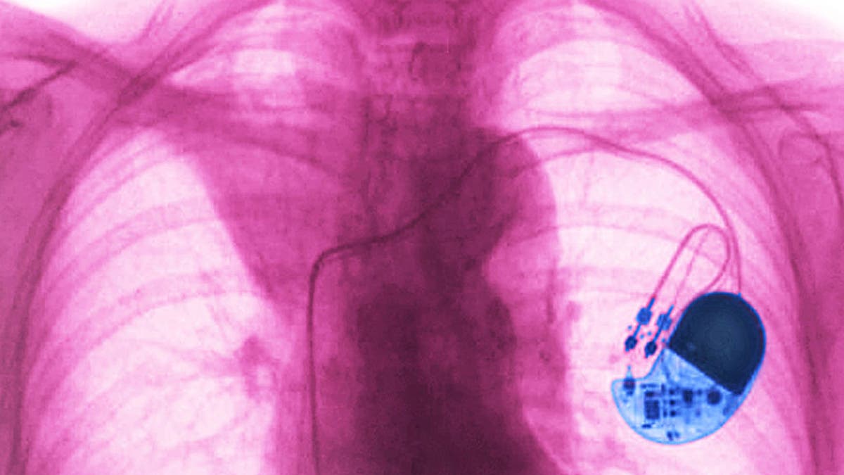 Pacemaker via x-ray