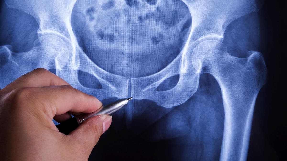 Pelvic bone x-ray