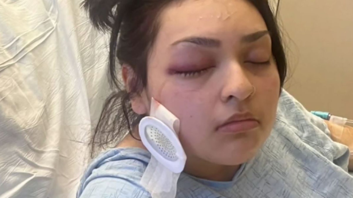 Bianca Palomera swollen eye