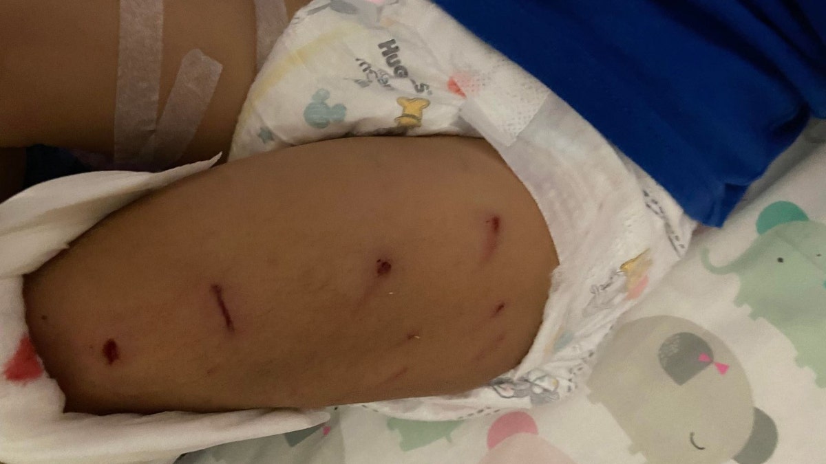 Scratches on the toddler's leg