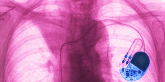 Pacemaker implanted in the chest. Frontal chest x-ray.