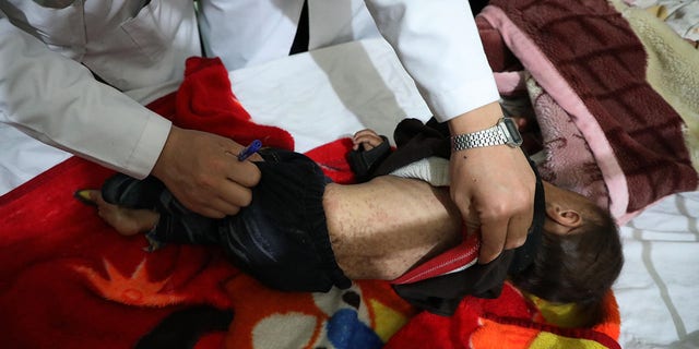Un bambino soffre di morbillo in Afghanistan durante lo scoppio di quest'anno della malattia mortale nel paese. 