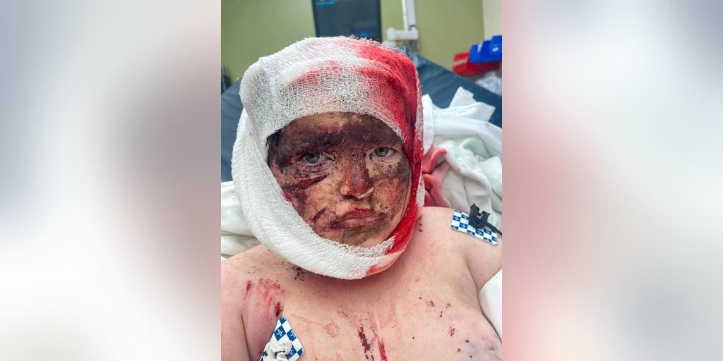 Georgia boy, 11, pulled from bike and attacked by 'loose' pit bulls loses part of ear, most of his scalp - Vimarsana News