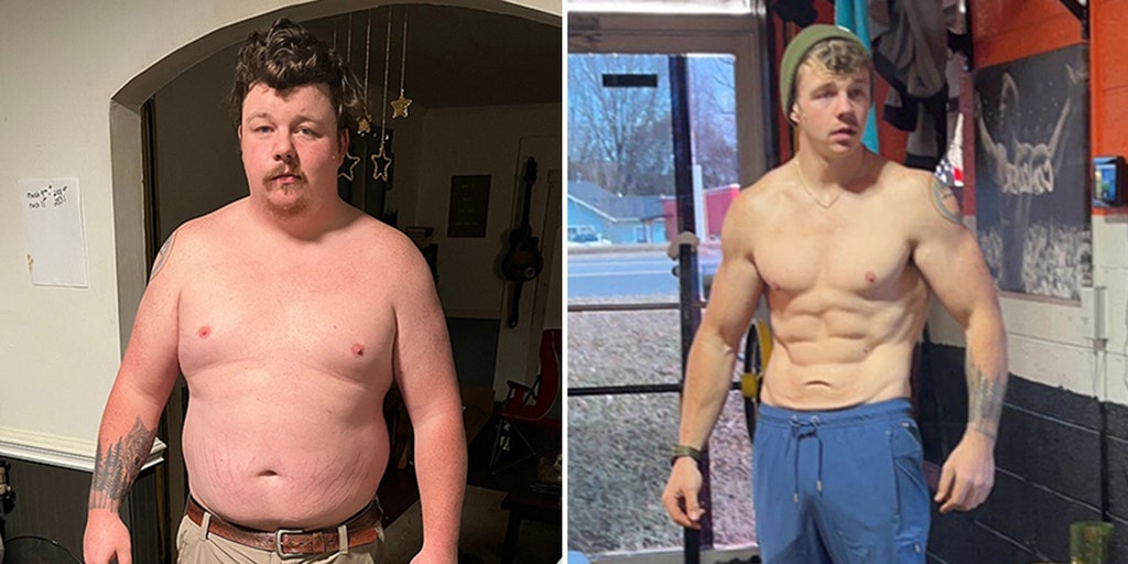 Saggy Breasts After Weight Loss: Mastopexy Options