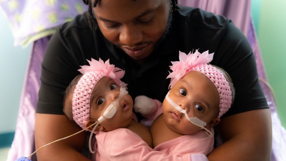 Conjoined Texas twins AmieLynn Rose and JamieLynn Rae Finley