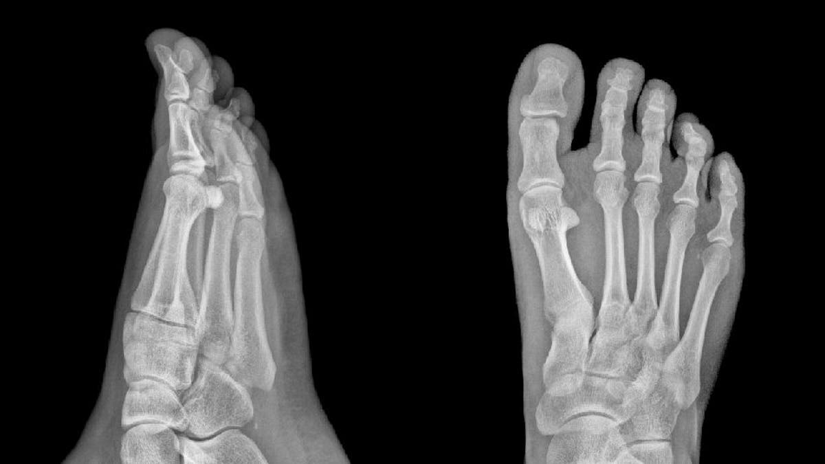 X-ray of two feet