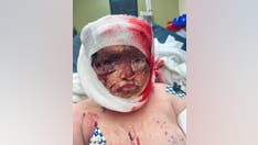 Georgia boy, 11, pulled from bike and attacked by 'loose' pit bulls loses part of ear, most of his scalp