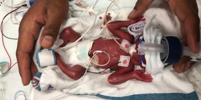 Amandi Omokore-Allen was born last January weighing 1 pound, 5 ounces.