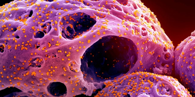 This colorized electron microscope image made available by the National Institute of Allergy and Infectious Diseases in November 2022, shows cells, indicated in purple, infected with the omicron strain of the SARS-CoV-2 virus, orange, isolated from a patient sample, captured at the NIAID Integrated Research Facility (IRF) in Fort Detrick, Maryland. 