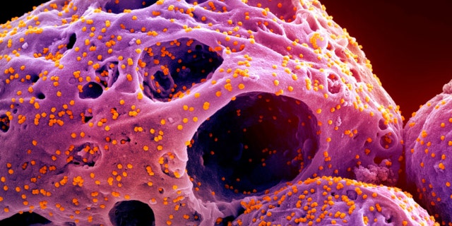 This colorized electron microscope image made available by the National Institute of Allergy and Infectious Diseases in November 2022, shows cells, indicated in purple, infected with the omicron strain of the SARS-CoV-2 virus, orange, isolated from a patient sample, captured at the NIAID Integrated Research Facility (IRF) in Fort Detrick, Maryland. 